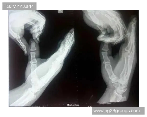 麦凯恩成功接受拇指韧带修复手术预计缺阵至少一个月 麦凯恩成功接受拇指韧带修复手术预计缺阵至少一个月